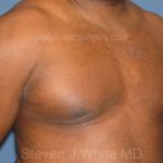 Male Breast Reduction - Gynecomastia Before & After Patient #2292