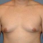 Male Breast Reduction - Gynecomastia Before & After Patient #2293