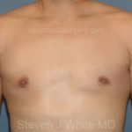 Male Breast Reduction - Gynecomastia Before & After Patient #2293