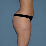 Liposuction - Body Before & After Patient #3145