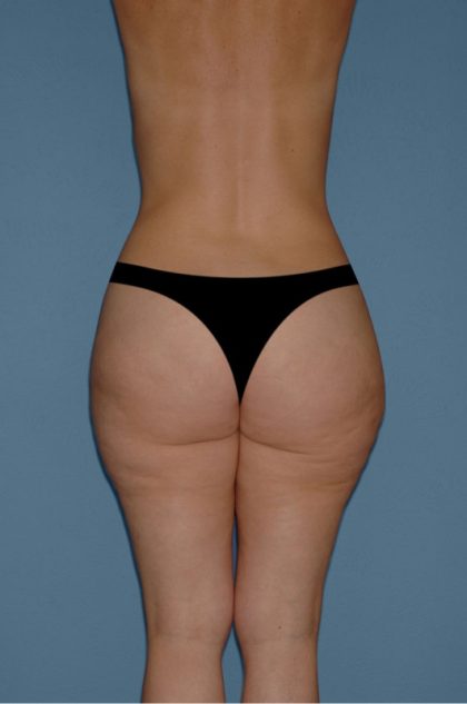 Liposuction - Body Before & After Patient #3145