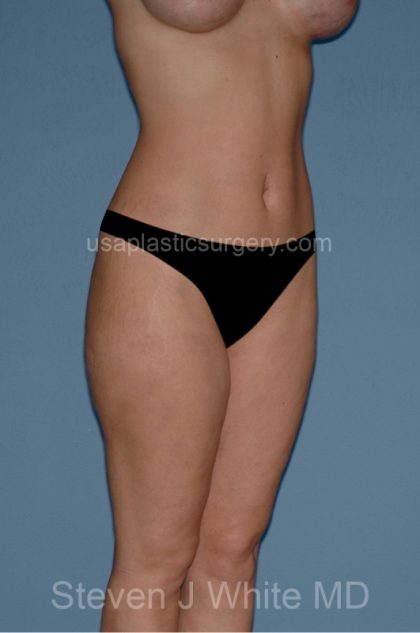 Liposuction - Body Before & After Patient #3062