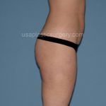 Liposuction - Body Before & After Patient #3062