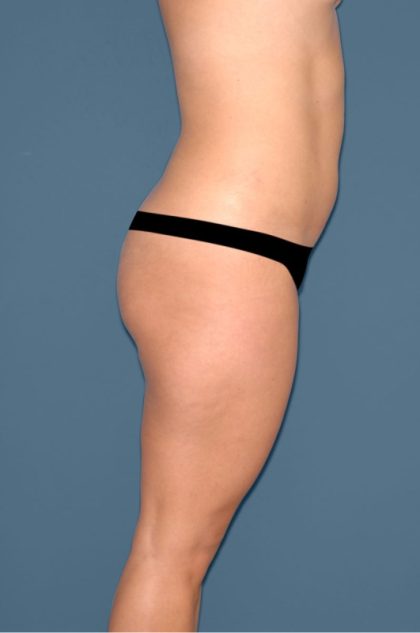 Liposuction - Body Before & After Patient #3053