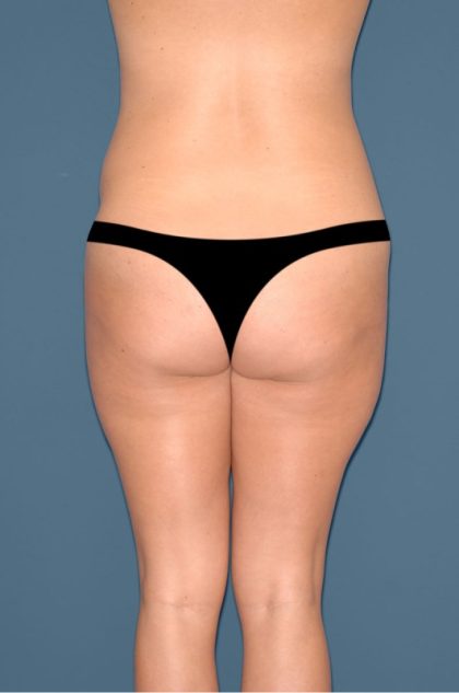 Liposuction - Body Before & After Patient #3053