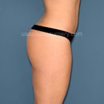 Liposuction - Body Before & After Patient #3043