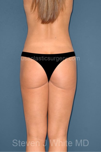 Liposuction - Body Before & After Patient #3043