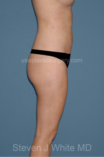 Liposuction - Body Before & After Patient #3042