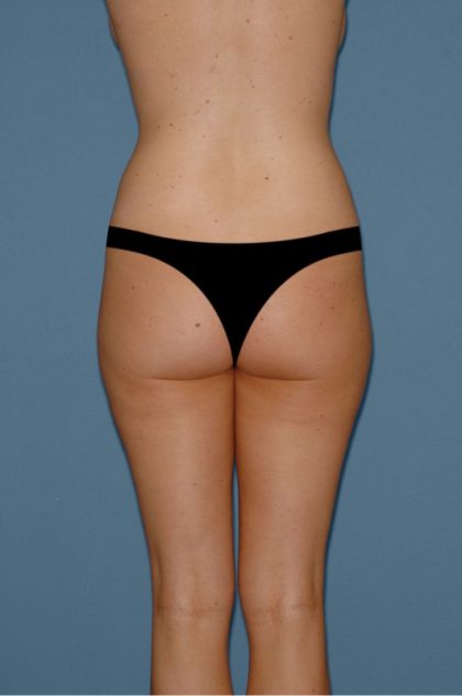 Liposuction - Body Before & After Patient #3042