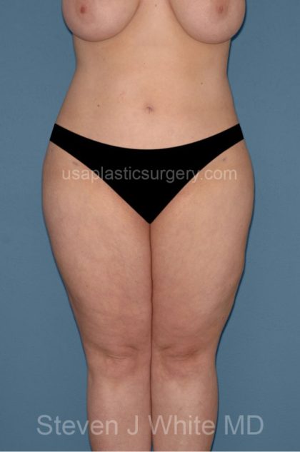 Liposuction - Body Before & After Patient #3021