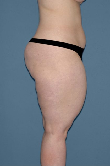 Liposuction - Body Before & After Patient #3021