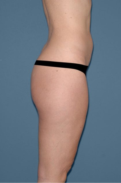 Liposuction - Body Before & After Patient #3000