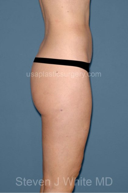 Liposuction - Body Before & After Patient #3000