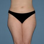 Liposuction - Body Before & After Patient #2999