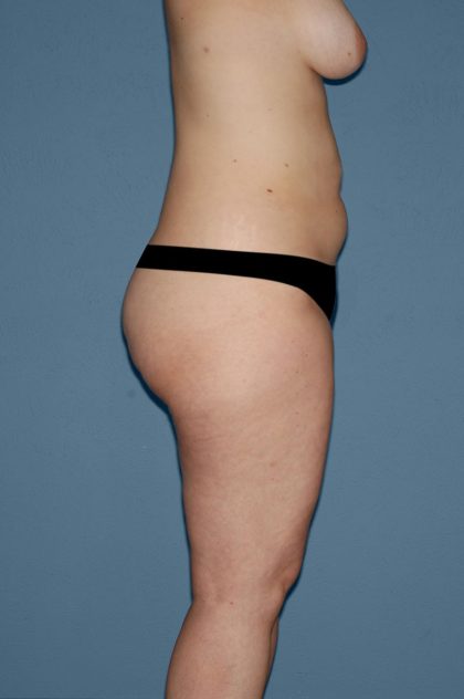 Liposuction - Body Before & After Patient #2999