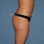 Liposuction - Body Before & After Patient #2990