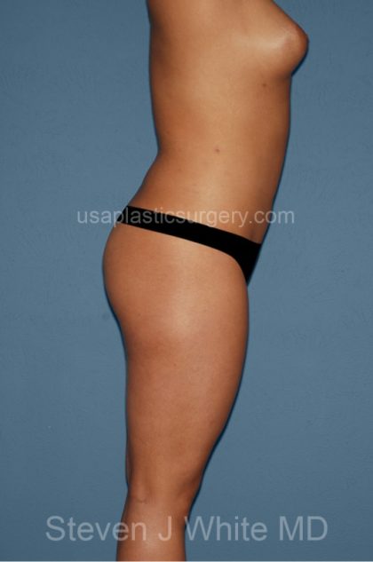 Liposuction - Body Before & After Patient #2990