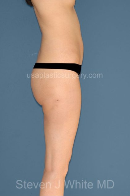 Liposuction - Body Before & After Patient #3141