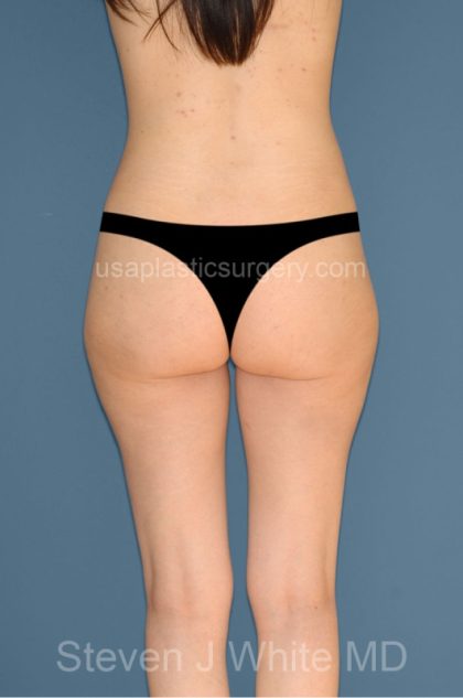 Liposuction - Body Before & After Patient #3141
