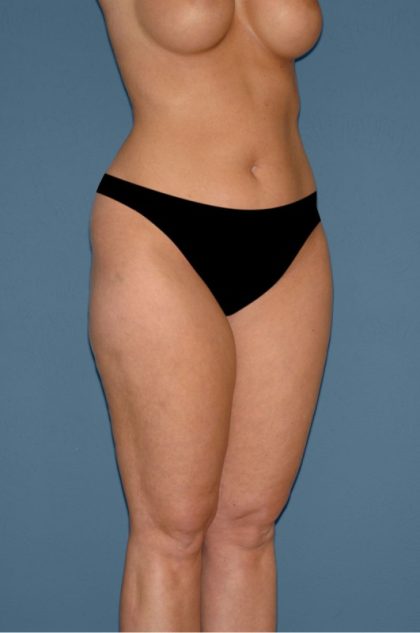 Liposuction - Body Before & After Patient #3127