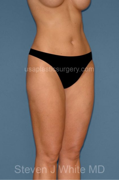 Liposuction - Body Before & After Patient #3127