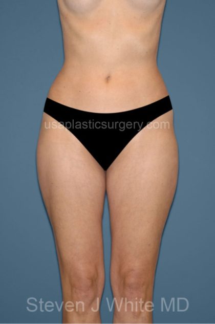 Liposuction - Body Before & After Patient #3118