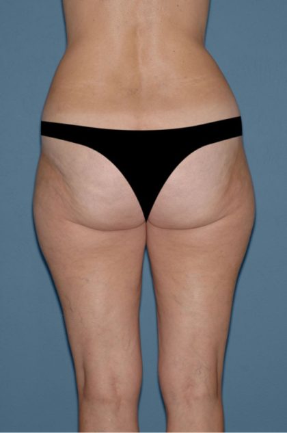 Liposuction - Body Before & After Patient #3118