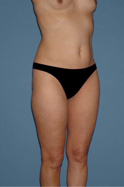 Liposuction - Body Before & After Patient #3109