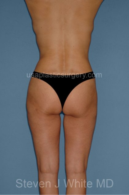 Liposuction - Body Before & After Patient #3109
