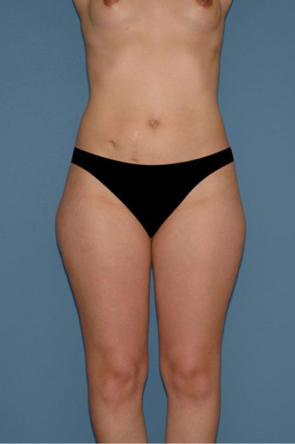 Liposuction - Body Before & After Patient #3099