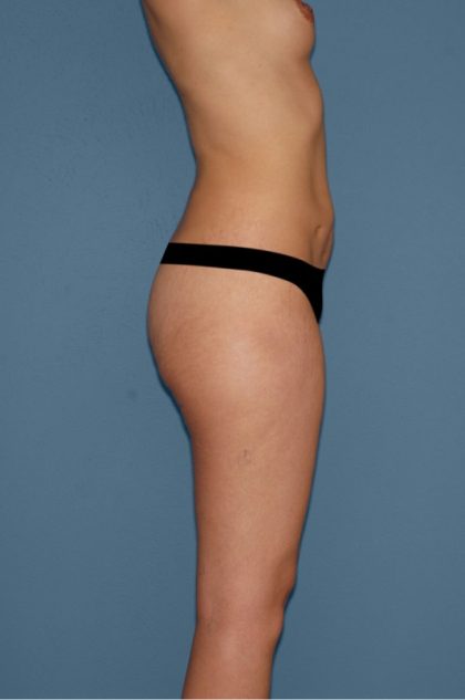 Liposuction - Body Before & After Patient #3099