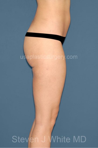 Liposuction - Body Before & After Patient #3090