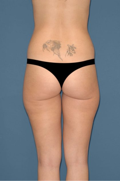 Liposuction - Body Before & After Patient #3090