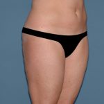 Liposuction - Body Before & After Patient #3081