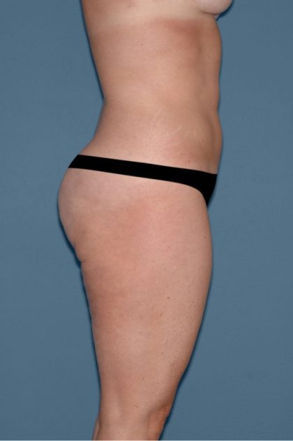 Liposuction - Body Before & After Patient #3081