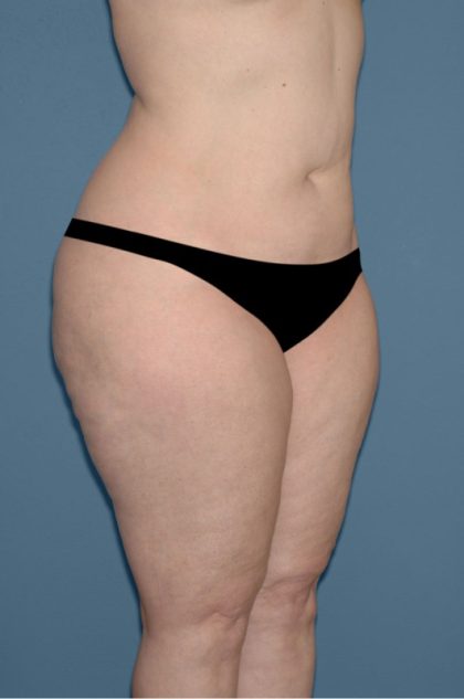 Liposuction - Body Before & After Patient #3071