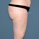 Liposuction - Body Before & After Patient #3071