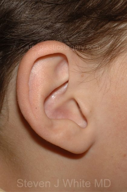 Ear Pinning - Otoplasty Before & After Patient #3299