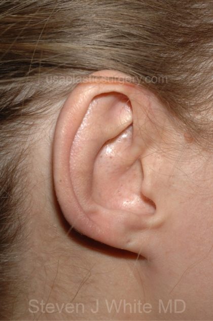Ear Pinning - Otoplasty Before & After Patient #3280