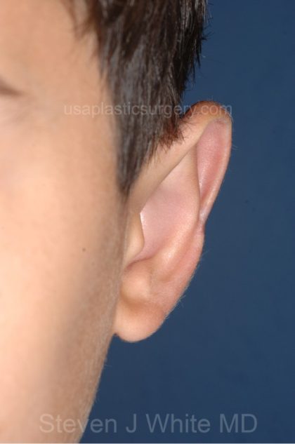 Ear Pinning - Otoplasty Before & After Patient #3167