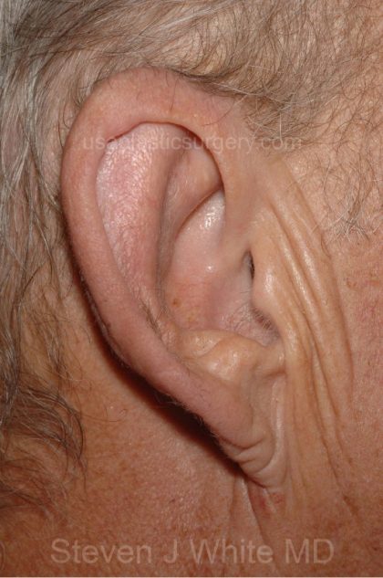Ear Pinning - Otoplasty Before & After Patient #3156