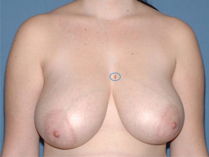 Breast Reduction Before & After Patient #3506