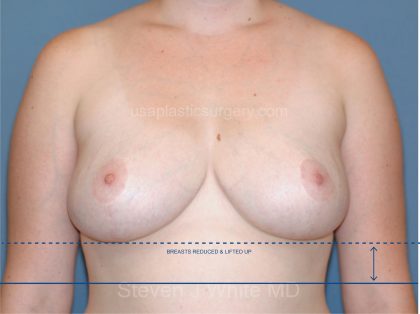 Breast Reduction Before & After Patient #3506