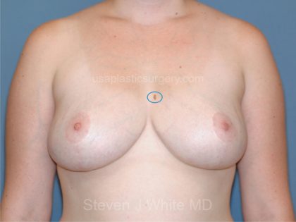 Breast Reduction Before & After Patient #3506