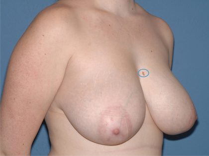 Breast Reduction Before & After Patient #3506