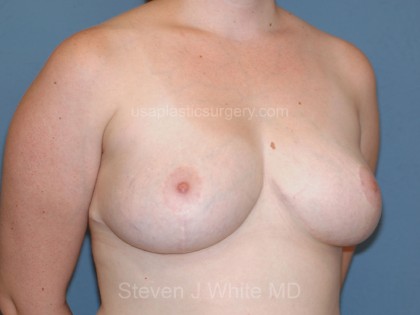 Breast Reduction Before & After Patient #3506