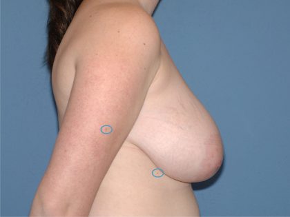 Breast Reduction Before & After Patient #3506