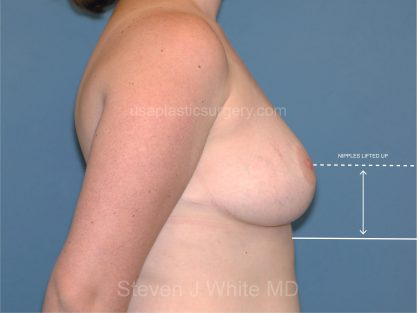Breast Reduction Before & After Patient #3506