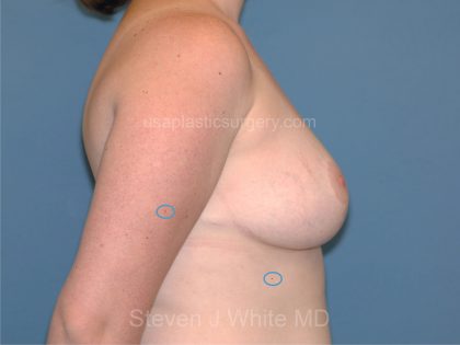 Breast Reduction Before & After Patient #3506