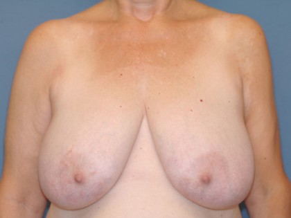 Breast Reduction Before & After Patient #3515
